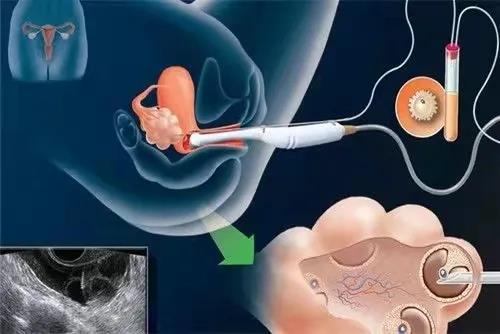 孕早期做阴道B超会不会影响胎儿？