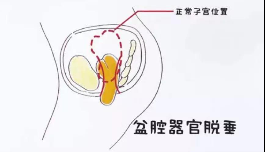 盆底肌多重要，你一定要知道