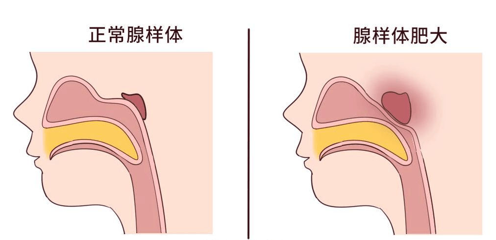 发现腺样体肥大就要“嘎一刀”？大可不必！