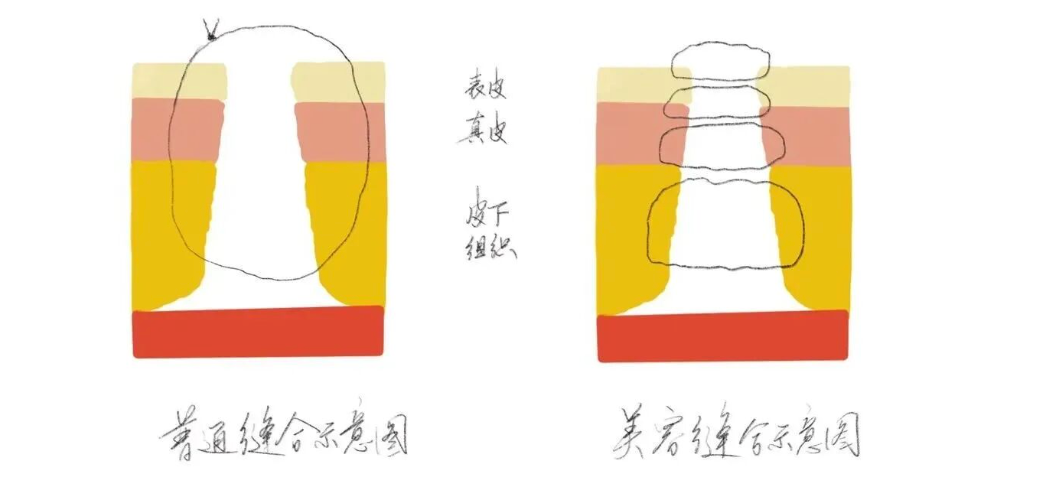 杭州美中宜和减张缝合技术改善产后瘢痕